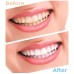 Tratamiento casero de blanqueamiento dental PM1295